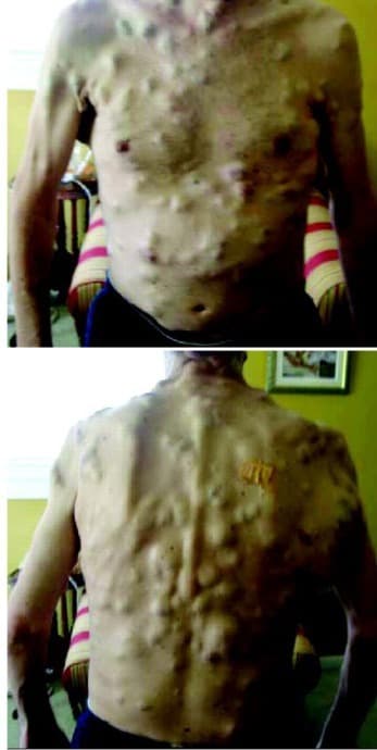 Panel A. Clinical photographs before a targeted BRAF inhibitor, front and back