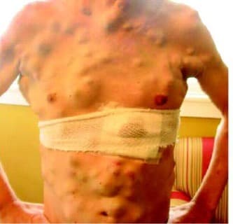 Panel C. Clinical photograph after relapse on a targeted BRAF inhibitor